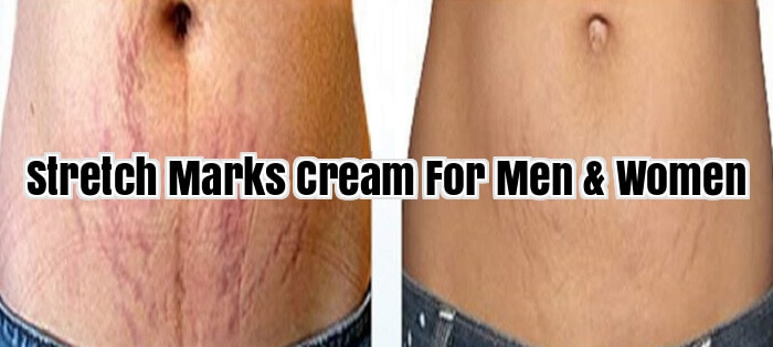 Stretch Marks Cream For Men & Women