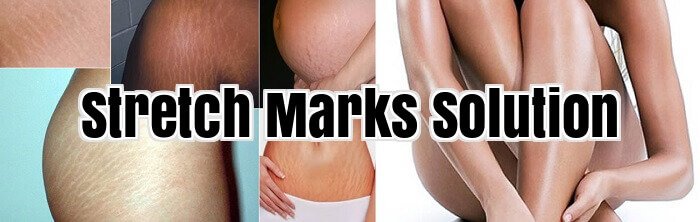Stretch Marks Solution