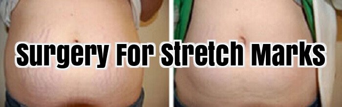 Surgery For Stretch Marks