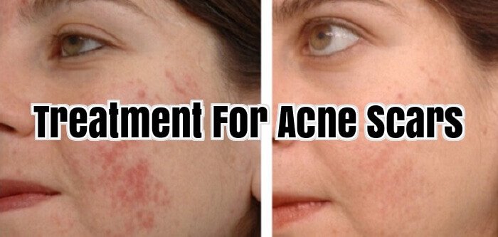 Treatment For Acne Scars