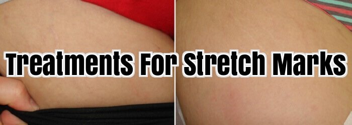 Treatments For Stretch Marks