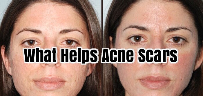 What Helps Acne Scars