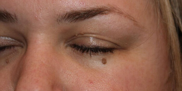 Get Rid Of Skin Tags On Eyelids