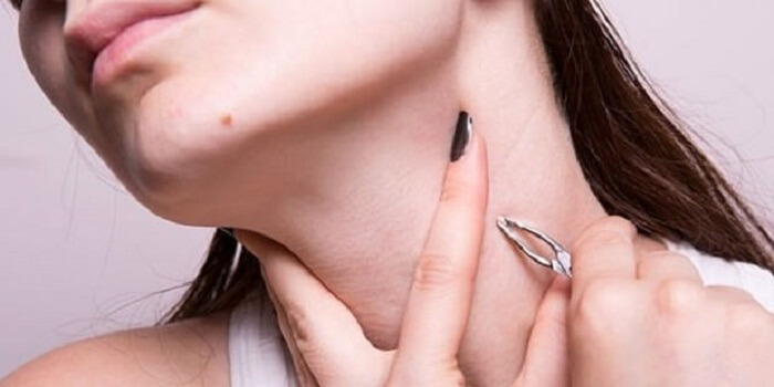 How To Get Rid Of Skin Tags