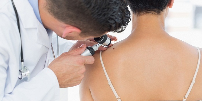 Laser Skin Tags Removal