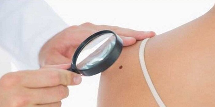 Removing Skin Tags – Is It Safe? What Causes Skin Tags?