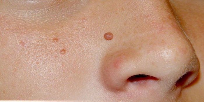 Skin Tags Removal At Home