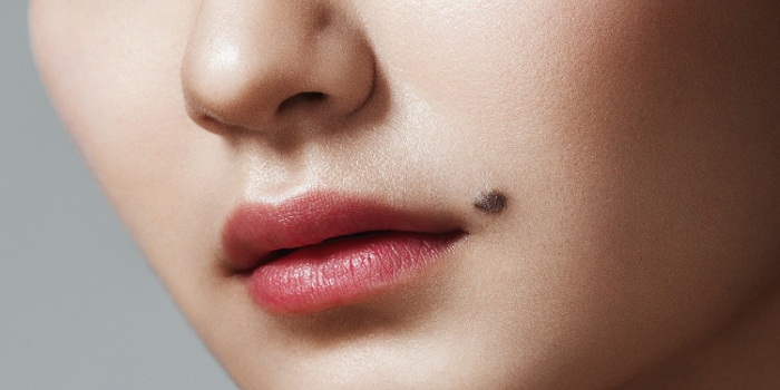 Tips On Skin Tag Removal