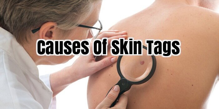 Causes of Skin Tags