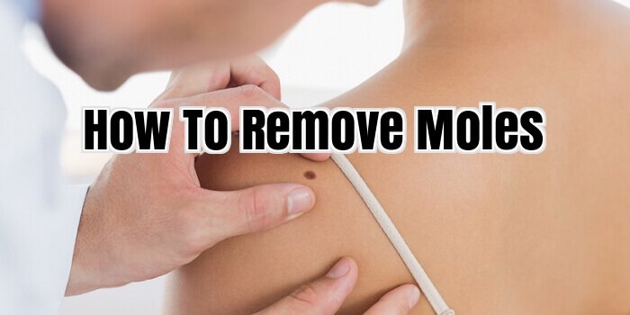 How to Remove Moles
