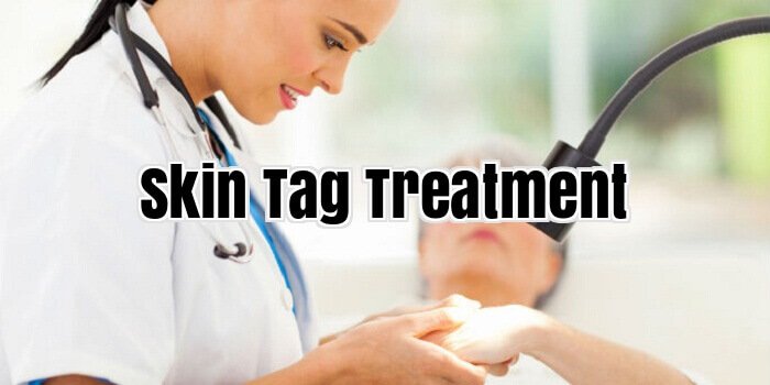 Skin Tag Treatment