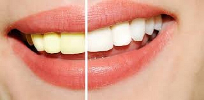 A Good Professional Teeth Whitening System Has To Address Your Individual Needs