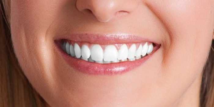 Home Teeth Whitening