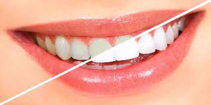 How Teeth Bleaching Differs From Teeth Whitening