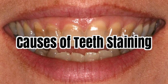 Causes of Teeth Staining