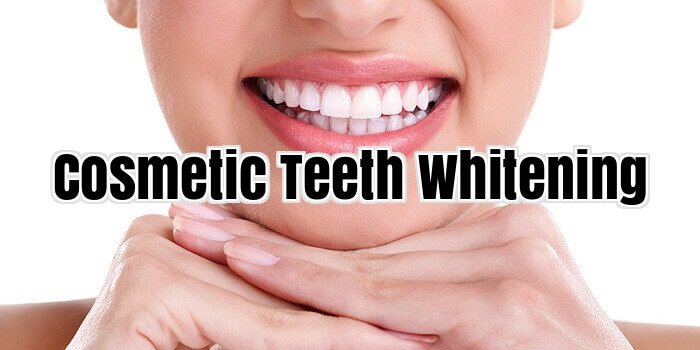 Cosmetic Teeth Whitening