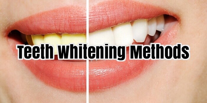 Teeth Whitening Methods