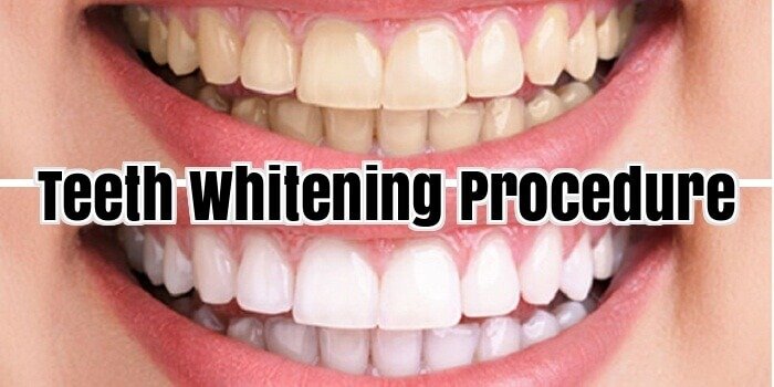 Teeth Whitening Procedure