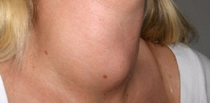 Thyroid Nodules Treatment