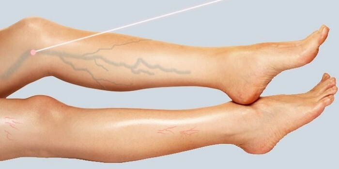 Cost of varicose veins Treatment