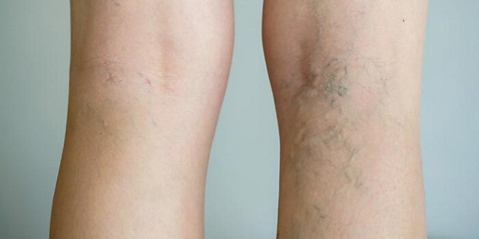 Delay In Opting For varicose veins Treatment May Take Away Your Mobility