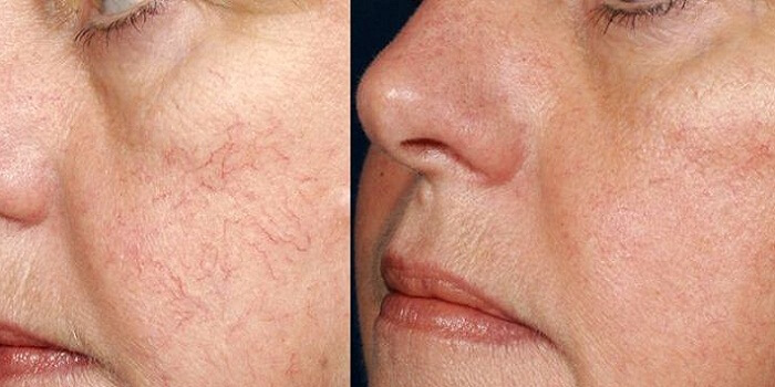 Facial varicose veins and Treatment