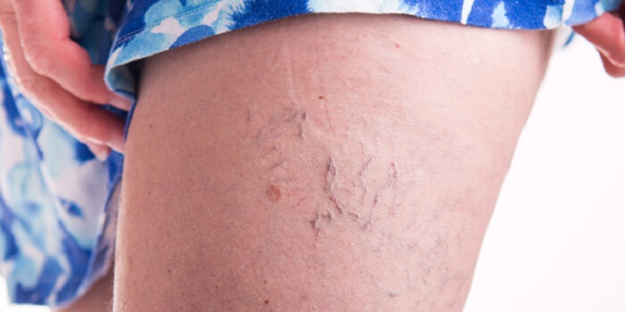 How to Cope with varicose veins