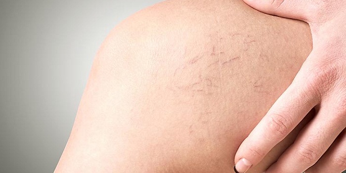 Prevention of varicose veins: Treatment Options