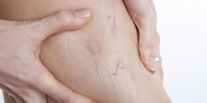 varicose veins Home Treatment: Plan Your Diet
