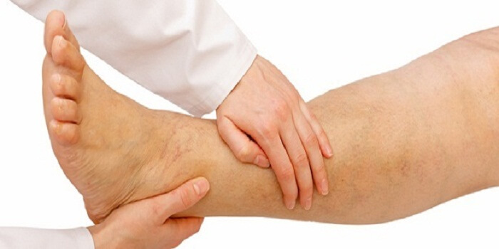 varicose veins Pain Treatment