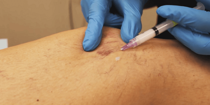 varicose veins Treatment Side Effects
