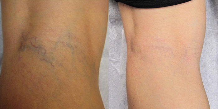 varicose veins Removal and Treatment