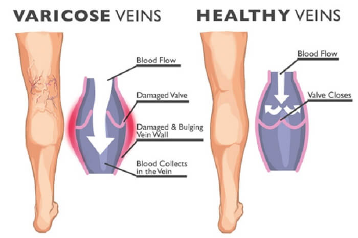 Home Remedies For varicose veins