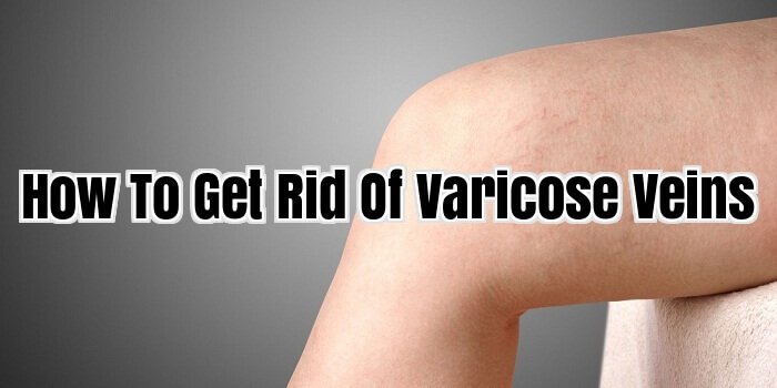 How To Get Rid of varicose veins