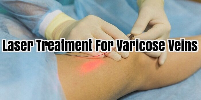 Laser Treatment For varicose veins