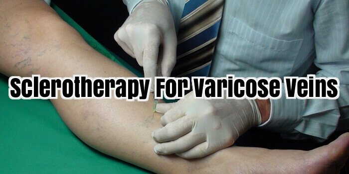 Sclerotherapy For varicose veins