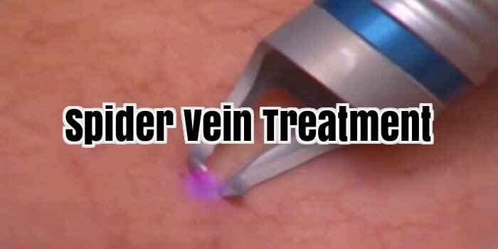 Spider Vein Treatment