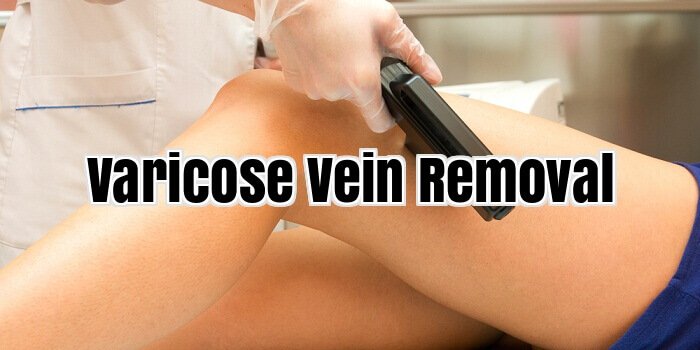 varicose veins Removal