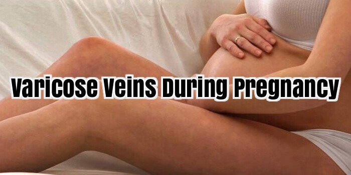 varicose veins During Pregnancy