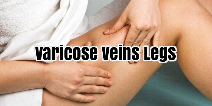 varicose veins Legs