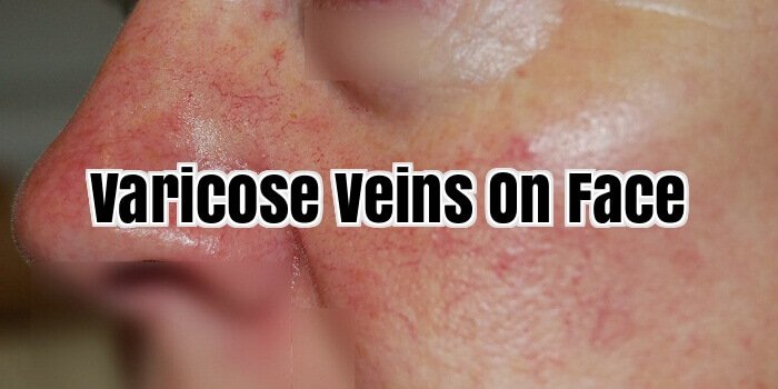 varicose veins on Face