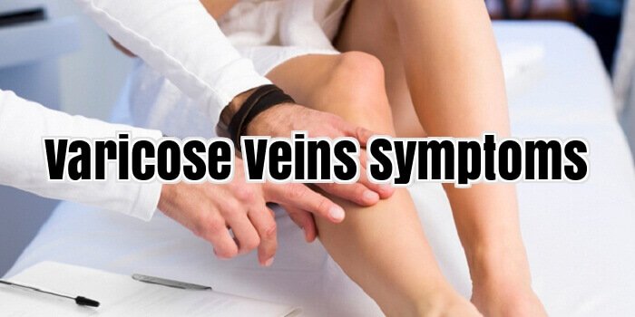 varicose veins Symptoms