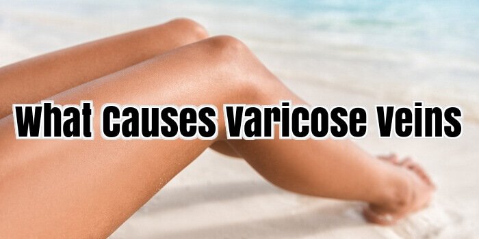 What Causes varicose veins