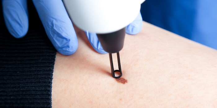 Comparison Of Warts And Moles