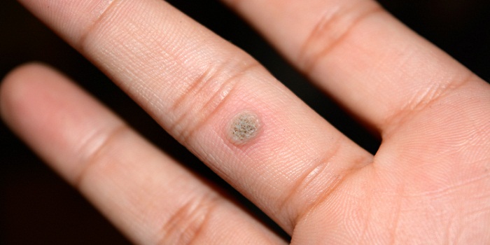 Genital Wart Removal