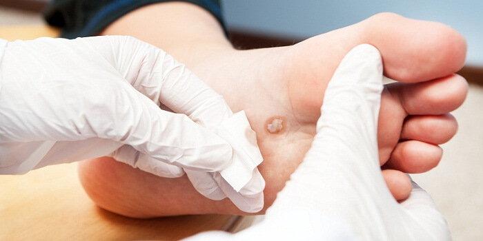 The Best And Safest Genital Warts Removal Methods