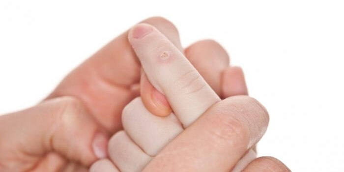 How to Remove a Wart