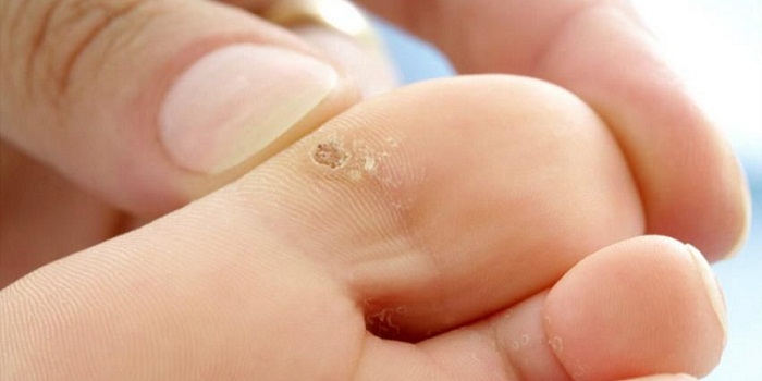 How To Remove Warts At Home