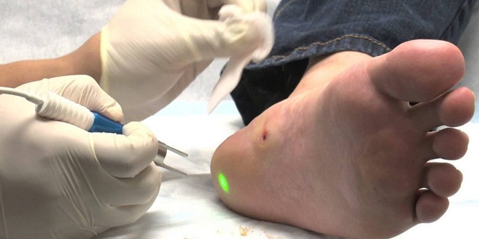 Laser Wart Removal