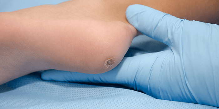 Removal of Wart